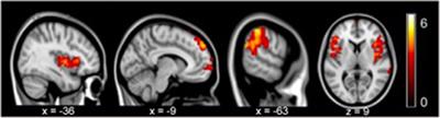 The Impact of Whole Brain Global Functional Connectivity Density Following MECT in Major Depression: A Follow-Up Study